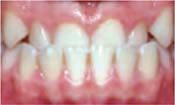 Anterior Crossbite